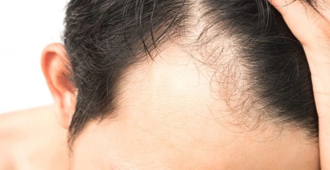 How To Choose The Right Hair Transplant Center In Turkey?