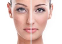 Things You Need To Know When Opting For A Facial Rejuvenation Treatment