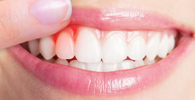 How Plaque And Gum Disease Affect Your Health