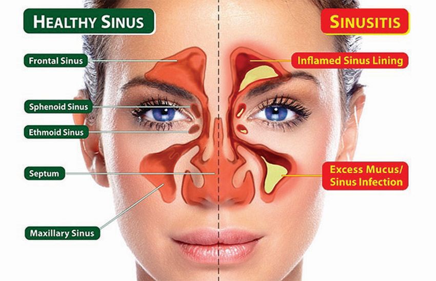 Sinus Problems