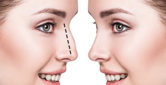 Health Motivated Reasons to Consider a Nose Job