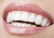 Invisalign – Understanding the Pros and the Cons
