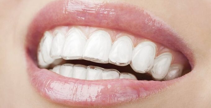 Invisalign – Understanding the Pros and the Cons