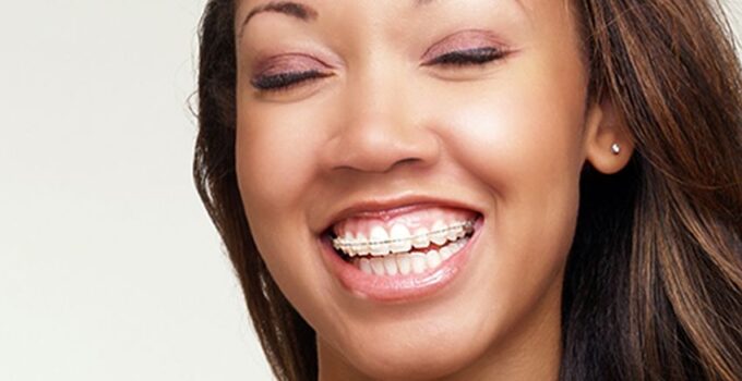 Smile With Confidence – What You Need To Know About Wearing Braces