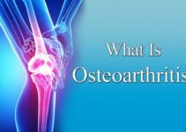 What is Osteoarthritis and What Can You Do to Manage It?