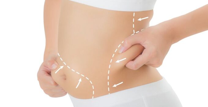 4 Fat Removal Procedures and How to Determine the Best Option for You