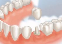 What Are Dental Crowns Used For?