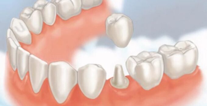 What Are Dental Crowns Used For?