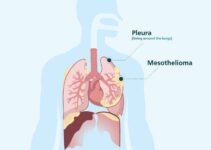 What You Should Know About Mesothelioma in 2024