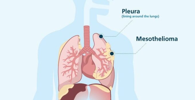 What You Should Know About Mesothelioma in 2024