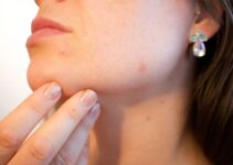 What Causes Acne? Possible Causes of Acne You Should Know