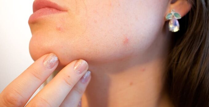 What Causes Acne? Possible Causes of Acne You Should Know