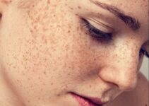 8 Natural Ways You Can Reduce Hyperpigmentation – 2024 Guide