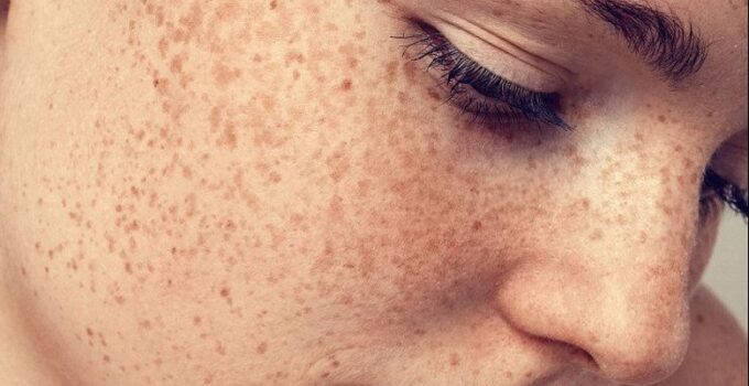 8 Natural Ways You Can Reduce Hyperpigmentation – 2024 Guide