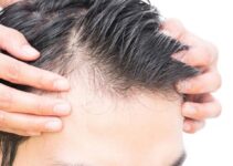 Hair Loss – What you Need to Know About Alopecia in 2024