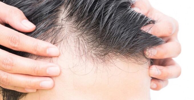 Hair Loss – What you Need to Know About Alopecia in 2024