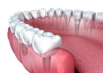 9 Questions to Ask Before Having Dental Implants In 2024