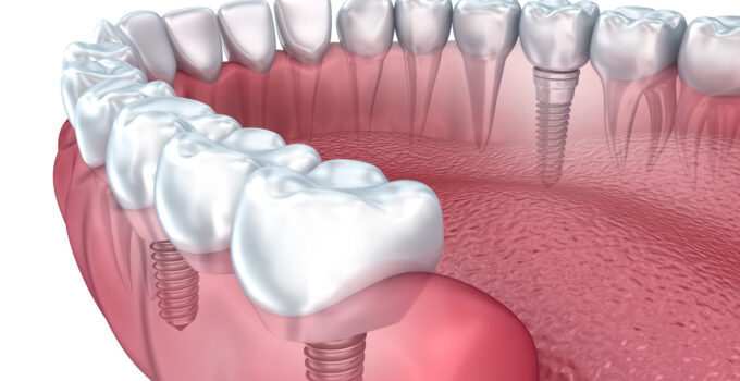 9 Questions to Ask Before Having Dental Implants In 2024