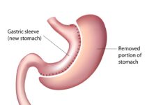 How Long Does it Take to Lose Weight After Gastric Sleeve Surgery