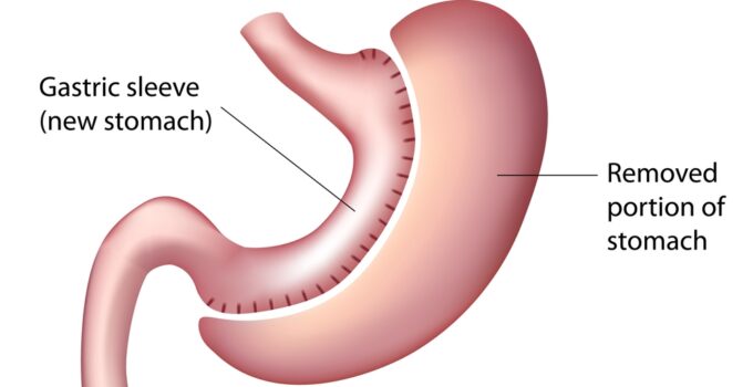 How Long Does it Take to Lose Weight After Gastric Sleeve Surgery