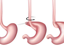 What Food Can I Eat After Nissen Fundoplication Surgery