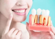 Benefits and Downsides of Having Dental Implants