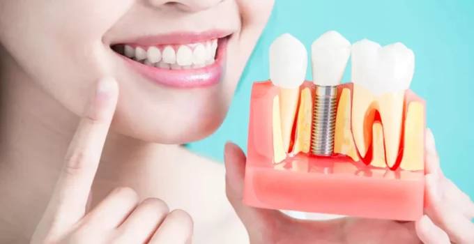 Benefits and Downsides of Having Dental Implants