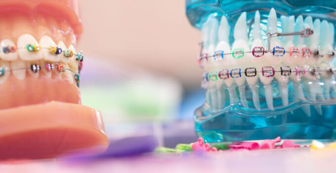 8 Things to Know Before Hiring the Best Orthodontist