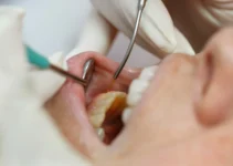 5 Things You Need to Know About Laser Dental Surgery