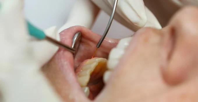 5 Things You Need to Know About Laser Dental Surgery