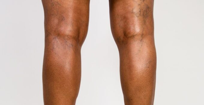 How to Locate Veins on Dark Skin Using Vein Finder