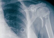 PEMF of Bone Healing