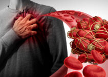 How to Avoid Blood Clots – Possible Risks, Basic Symptoms, Different Treatments and Methods for Prevention