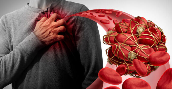 How to Avoid Blood Clots – Possible Risks, Basic Symptoms, Different Treatments and Methods for Prevention