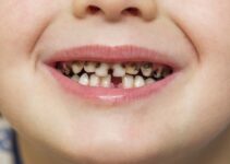 All About Cavities in Children and How to Deal With It