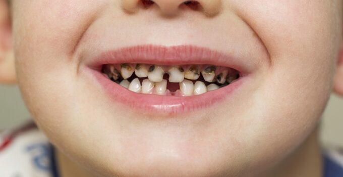 All About Cavities in Children and How to Deal With It