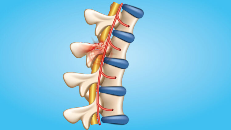 Spinal Cord Injuries - most Common Motorcycle Injuries