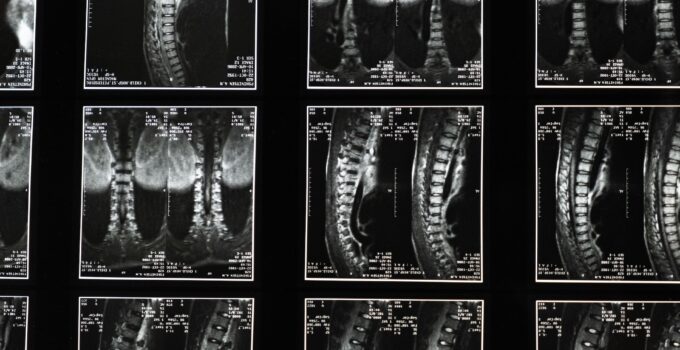 What Are Some Symptoms of Spinal Misalignment? – 2024 Guide