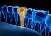 The Future of Dentistry: A Look at Dental Implant Technology