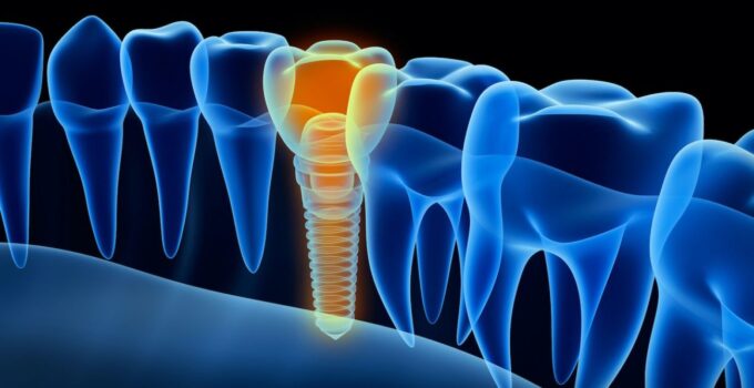 The Future of Dentistry: A Look at Dental Implant Technology