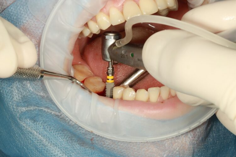 The Implant Procedure