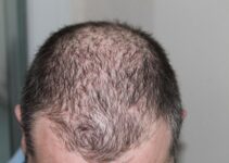 Reasons You May Be Experiencing Hair Loss