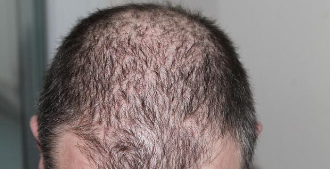 Reasons You May Be Experiencing Hair Loss