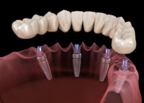 Discover the Future of Dentistry with 4 in 1 Implants: A Comprehensive Guide