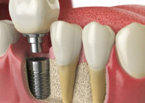 How Multiple Teeth Replacement Improves Oral Health How Multiple Teeth Replacement Improves Oral Health
