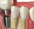 How Multiple Teeth Replacement Improves Oral Health