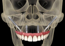 Zygomatic Arch Implants: Transform Your Smile with Confidence Zygomatic Arch Implants: Transform Your Smile with Confidence