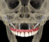 Zygomatic Arch Implants: Transform Your Smile with Confidence